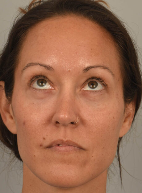 Eyelid Surgery case #11802