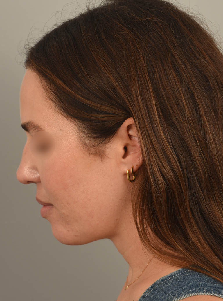 Deep Neck Contouring case #11347