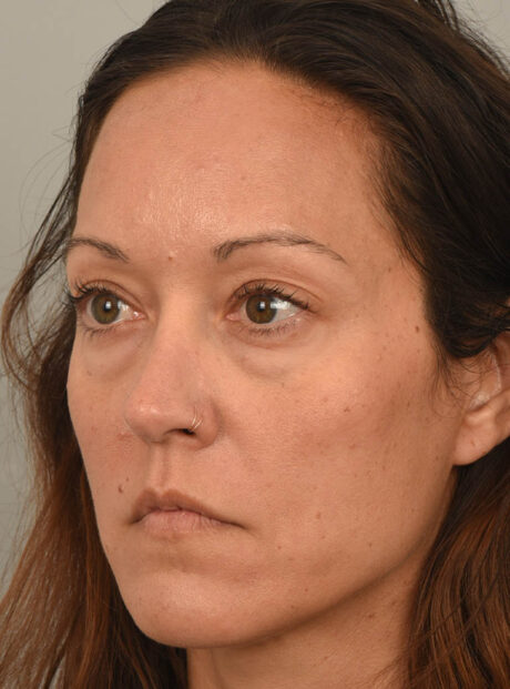 Eyelid Surgery case #11802