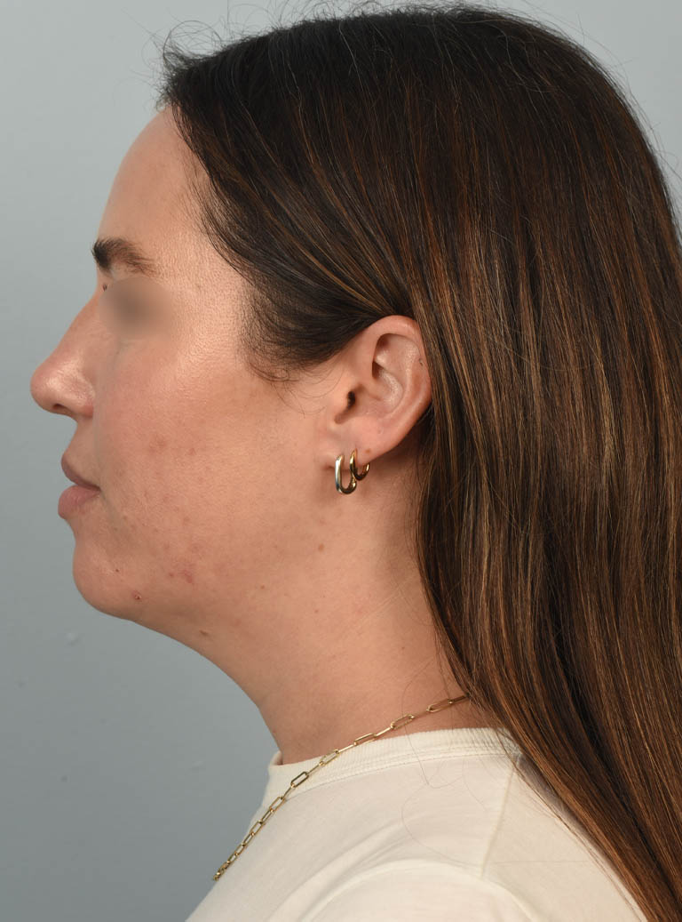 Deep Neck Contouring case #11347