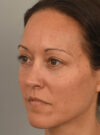 Eyelid Surgery case #11802