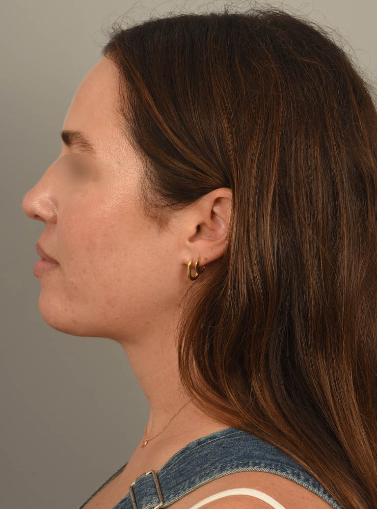 Deep Neck Contouring case #11347