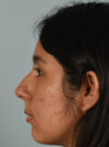 Rhinoplasty case #11714