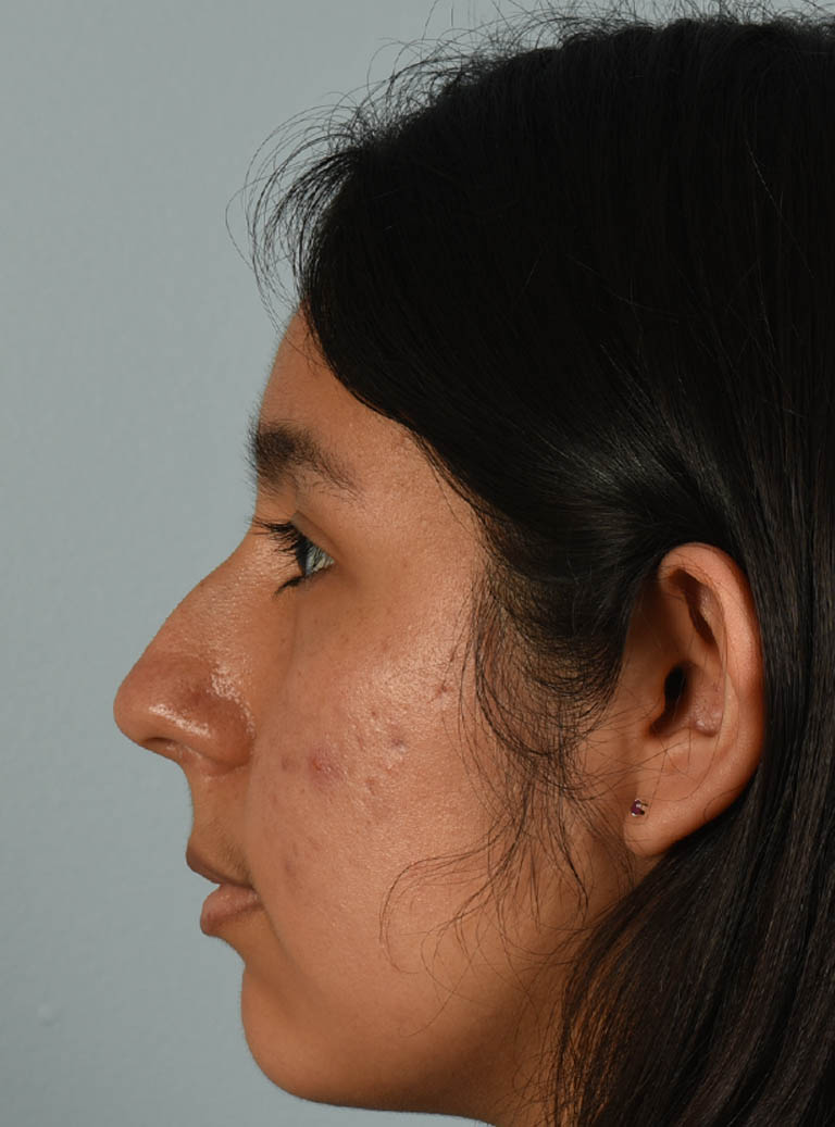 Rhinoplasty case #11714