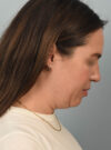 Deep Neck Contouring case #11347