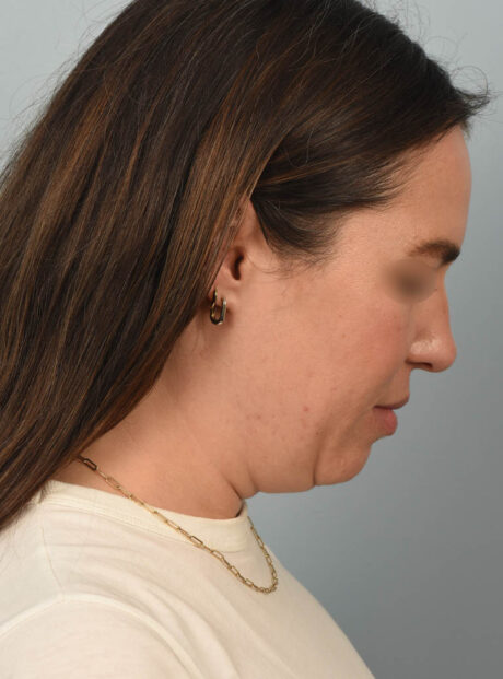 Deep Neck Contouring case #11347