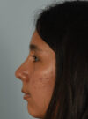 Rhinoplasty case #11714
