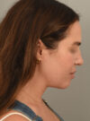 Deep Neck Contouring case #11347