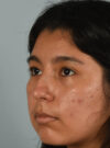 Rhinoplasty case #11714