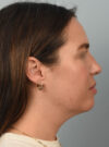 Deep Neck Contouring case #11347