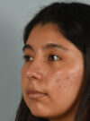 Rhinoplasty case #11714