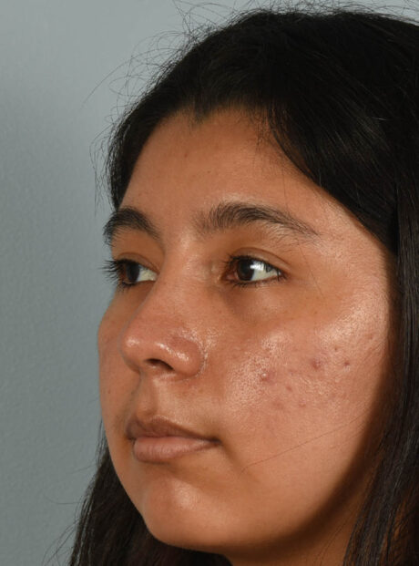 Rhinoplasty case #11714
