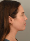 Deep Neck Contouring case #11347