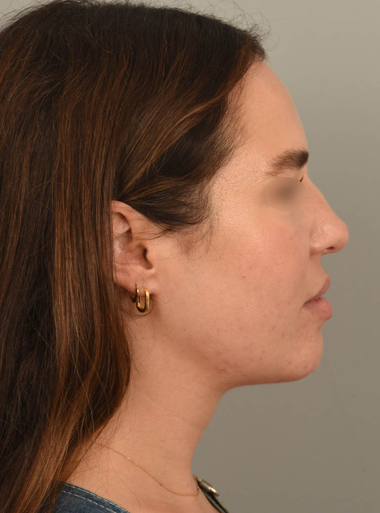 Deep Neck Contouring case #11347