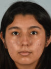 Rhinoplasty case #11714