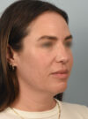 Deep Neck Contouring case #11347
