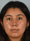 Rhinoplasty case #11714