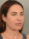 Deep Neck Contouring case #11347