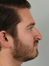 Rhinoplasty case #11721