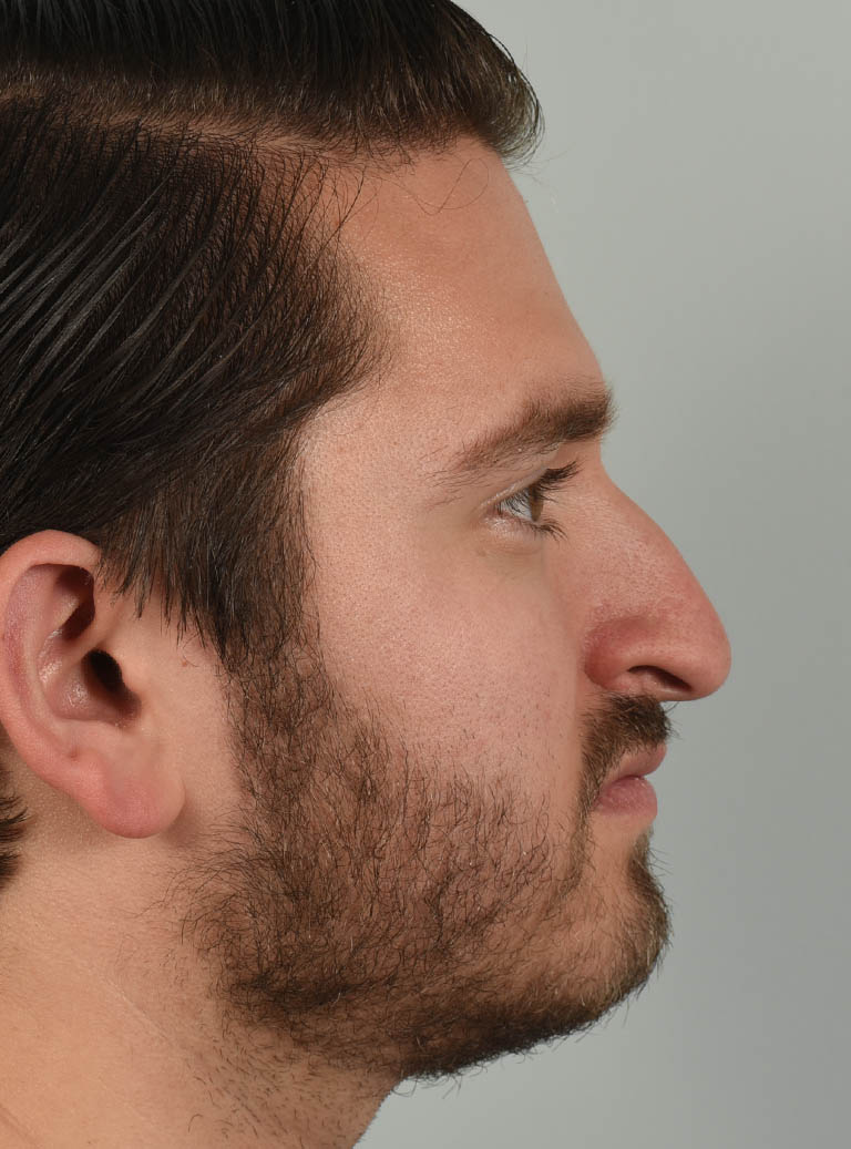Rhinoplasty case #11721