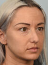 Eyelid Surgery case #11804
