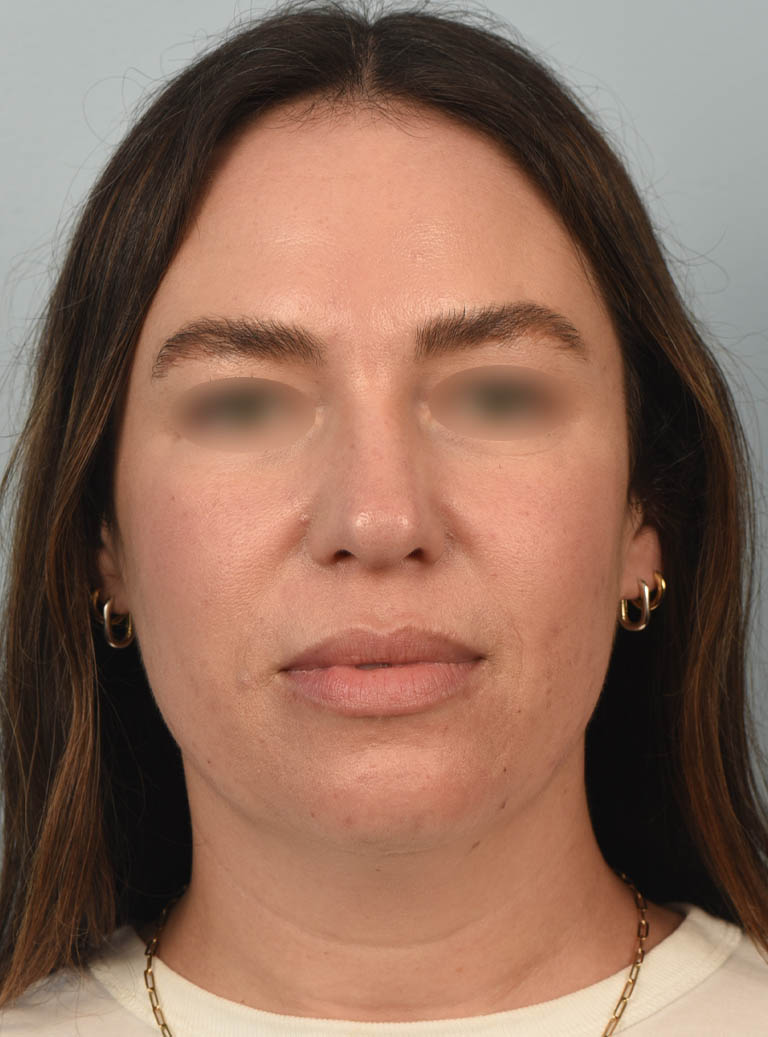 Deep Neck Contouring case #11347