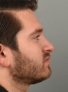 Rhinoplasty case #11721