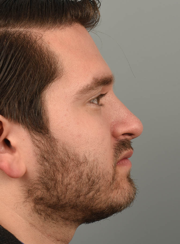 Rhinoplasty case #11721