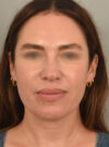 Deep Neck Contouring case #11347
