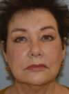 Eyelid Surgery case #11800