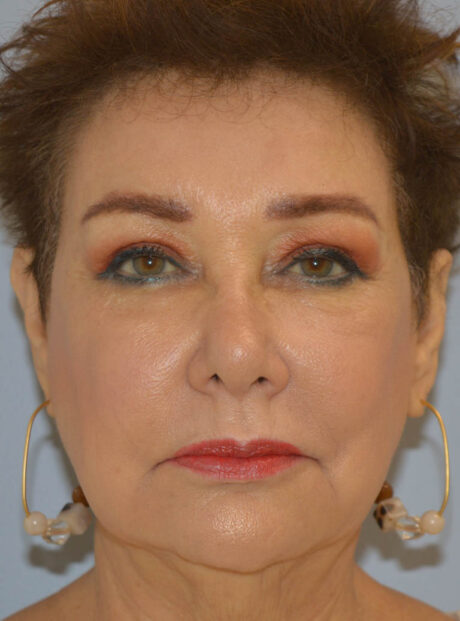 Eyelid Surgery case #11800
