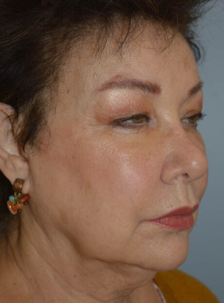 Eyelid Surgery case #11800