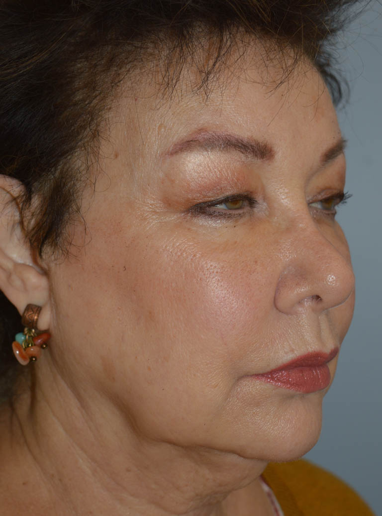 Eyelid Surgery case #11800