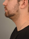 Deep Neck Contouring case #11338