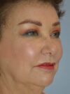 Eyelid Surgery case #11800