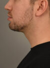 Deep Neck Contouring case #11338