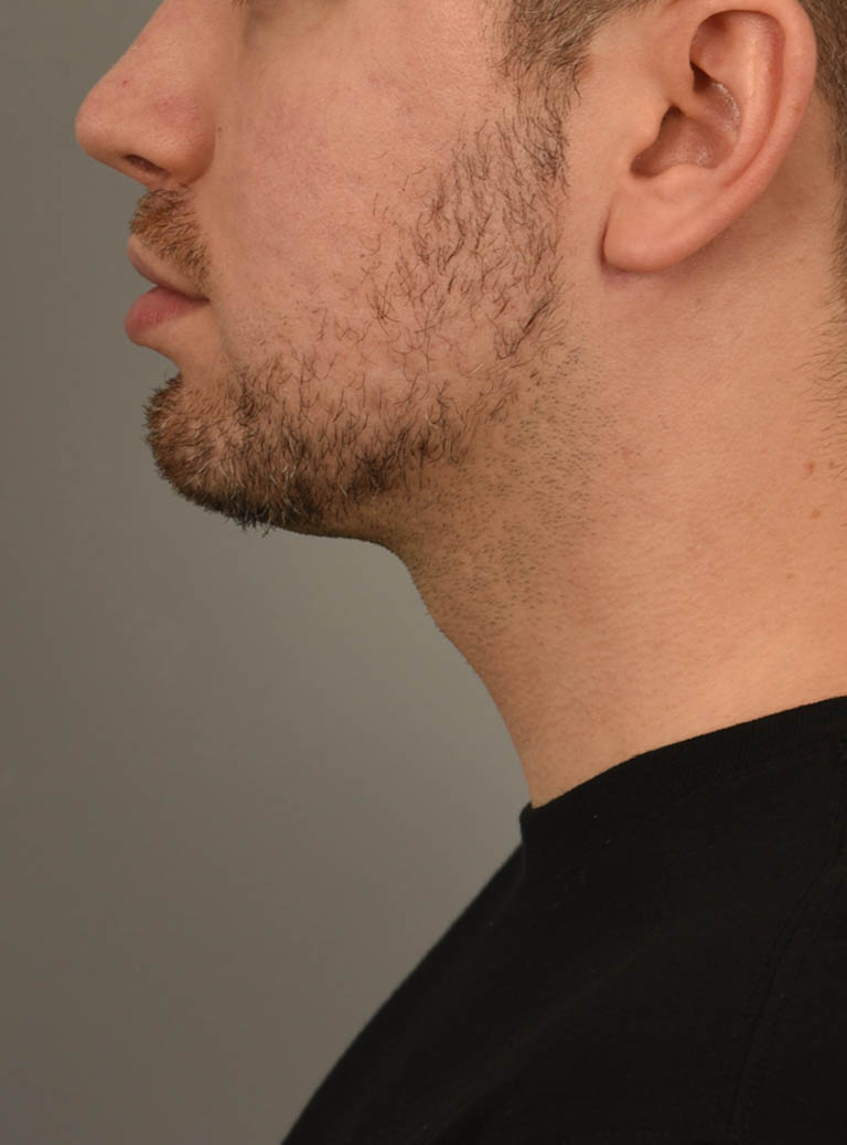 Deep Neck Contouring case #11338