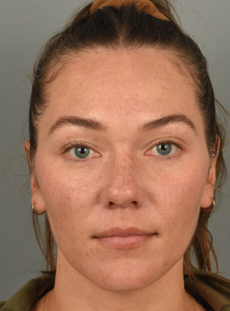 Rhinoplasty case #11708