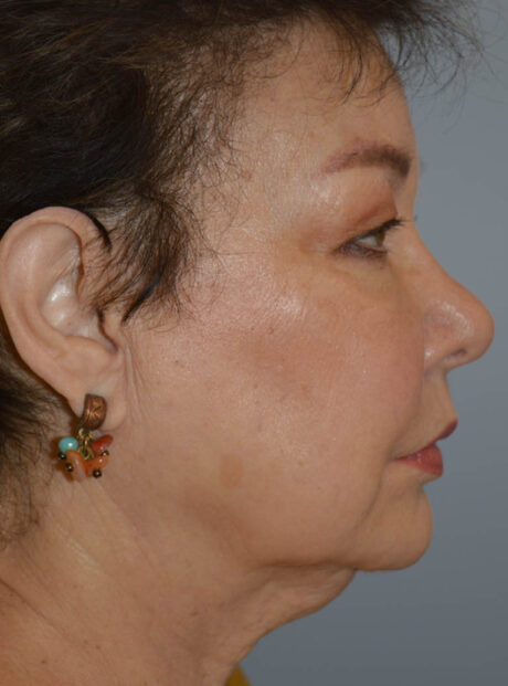 Eyelid Surgery case #11800