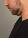 Deep Neck Contouring case #11338
