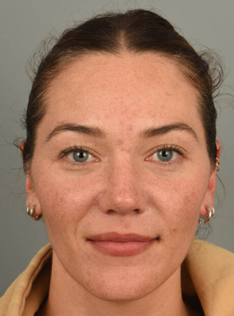Rhinoplasty case #11708