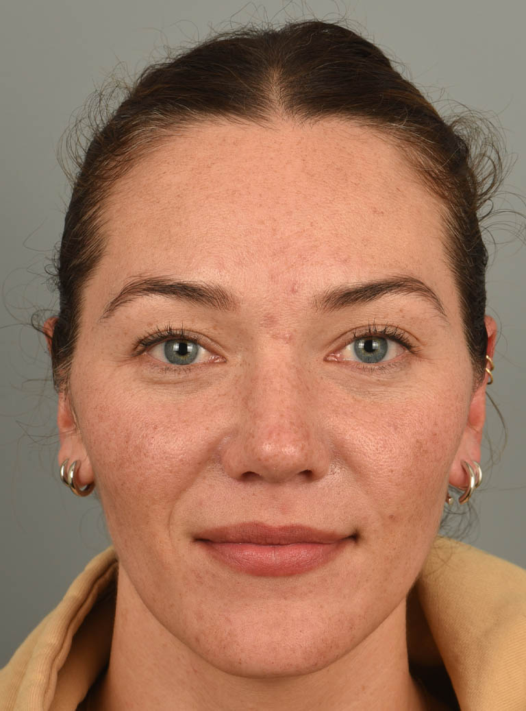 Rhinoplasty case #11708