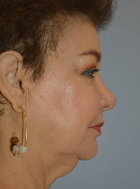 Eyelid Surgery case #11800