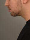 Deep Neck Contouring case #11338