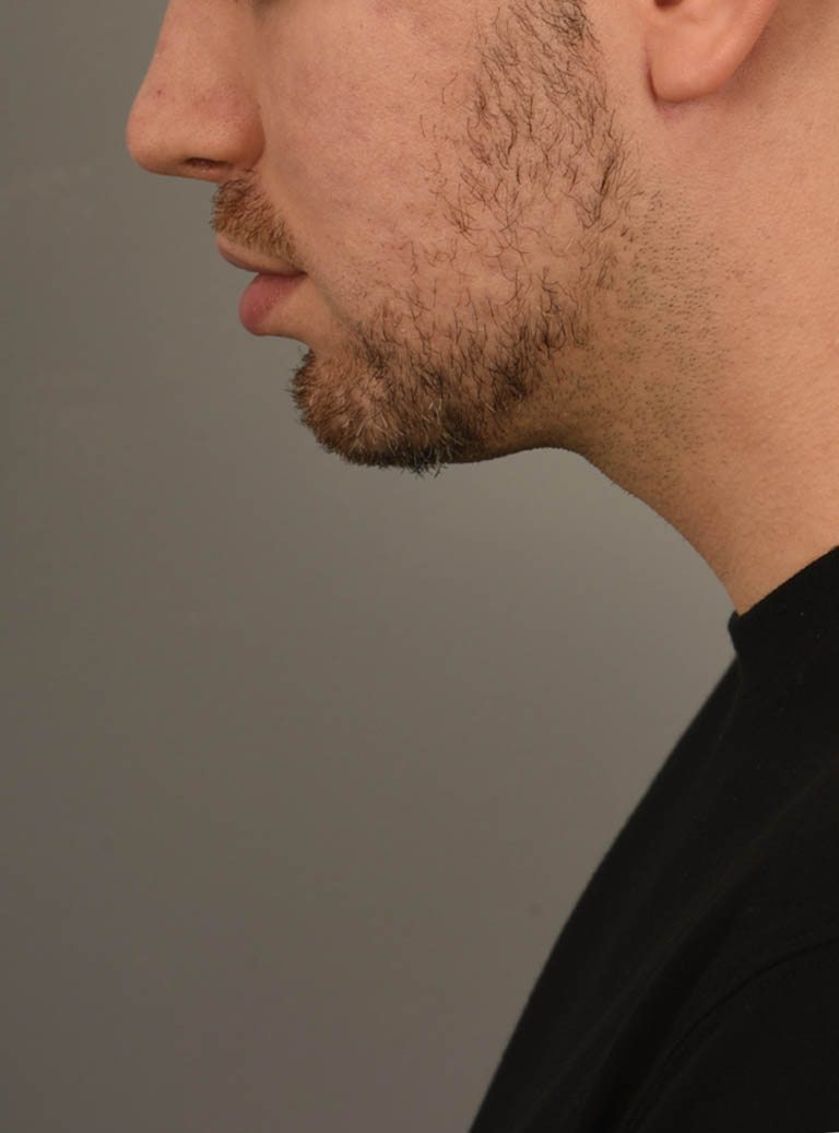 Deep Neck Contouring case #11338