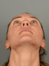 Rhinoplasty case #11708