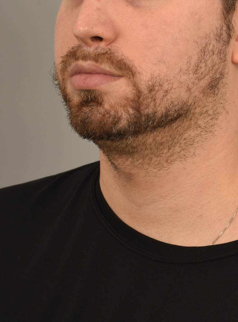 Deep Neck Contouring case #11338