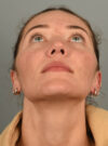 Rhinoplasty case #11708