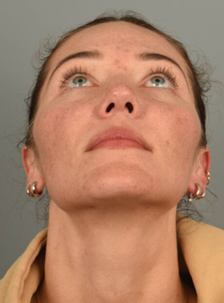 Rhinoplasty case #11708