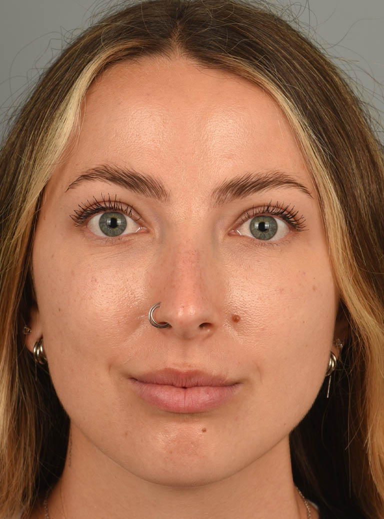 Eyelid Surgery case #11806